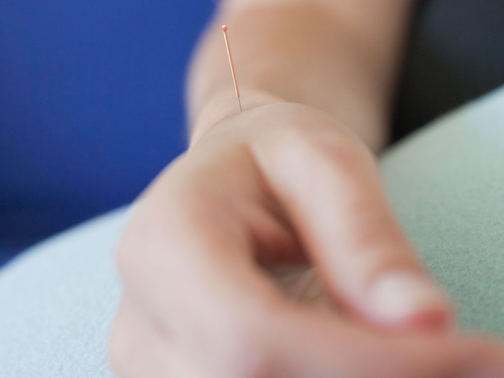 Hand mit platzierter Akupunkturnadel Hand mit platzierter Akupunkturnadel